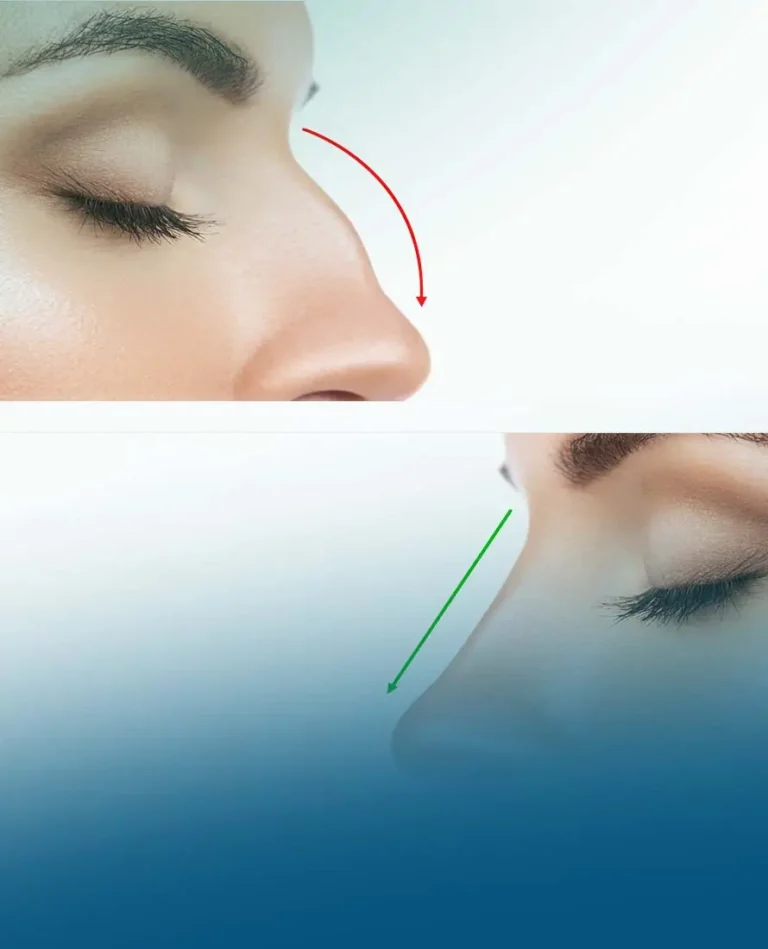 نتائج مثالية ملحوظة لعملية تجميل الأنف، موضحة بصورة قبل وبعد العملية.