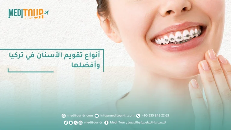 انواع تقويم الاسنان في تركيا