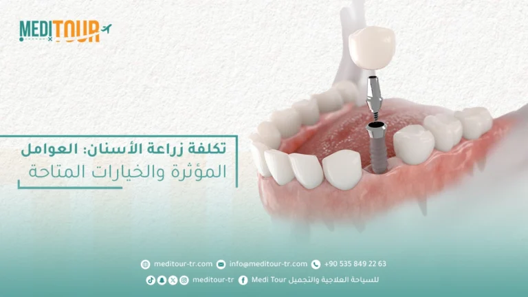 تكلفة زراعة الأسنان في تركيا