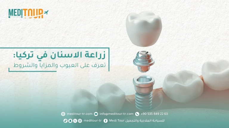 تعتبر زراعة الاسنان في تركيا خيارك الأفضل لاستعادة ابتسامة صحية وجميلة.