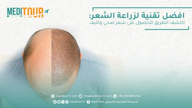 استخدام افضل تقنية لزراعة الشعر لتحقق نتائج مثالية
