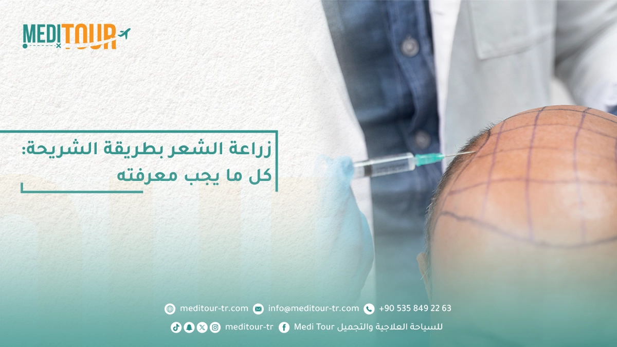 الطريقة المتبعة في زراعة الشعر بطريقة الشريحة