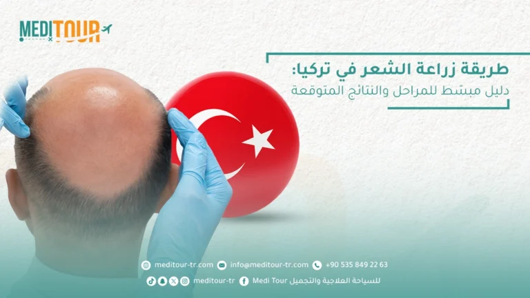 طريقة زراعة الشعر في تركيا تؤمن لك أفضل النتائج