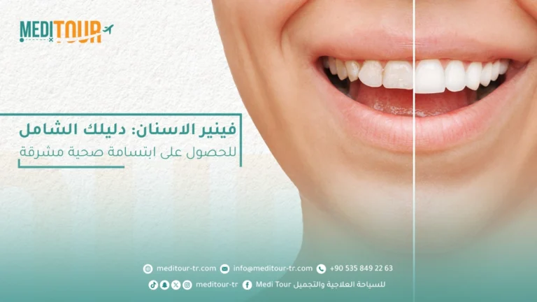 دليلك الشامل حول فينير الاسنان