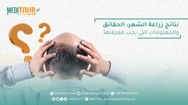 نتائج زراعة الشعر في تركيا تضمن لك التألق