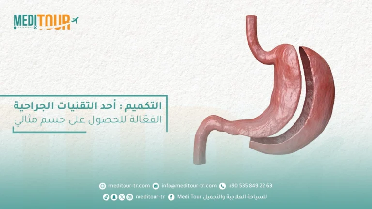 التكميم ودورة في علاج السمنة