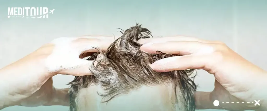 طريقة الغسيل لإزالة القشور بعد زراعة الشعر