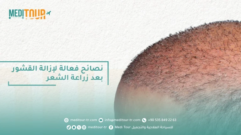 نصائح لتتمكن من إزالة القشور بعد زراعة الشعر