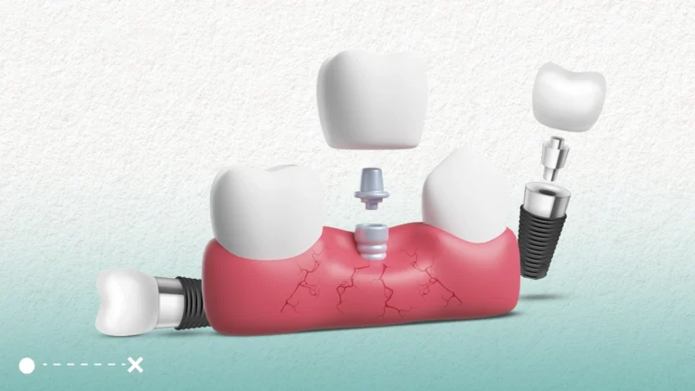 اضرار زراعة الاسنان بسيطة ويمكن تجنبها لذلك لا داعي للقلق.