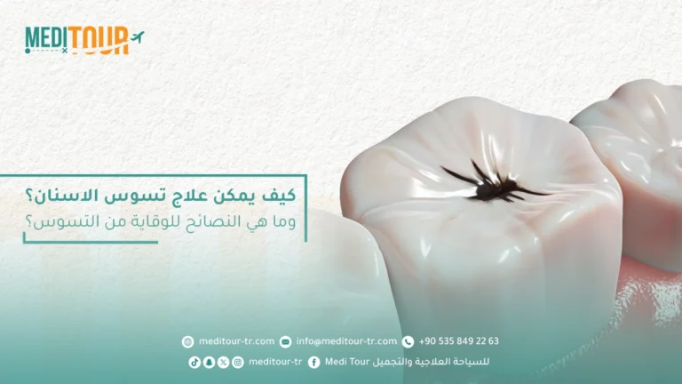 علاج تسوس الاسنان في تركيا