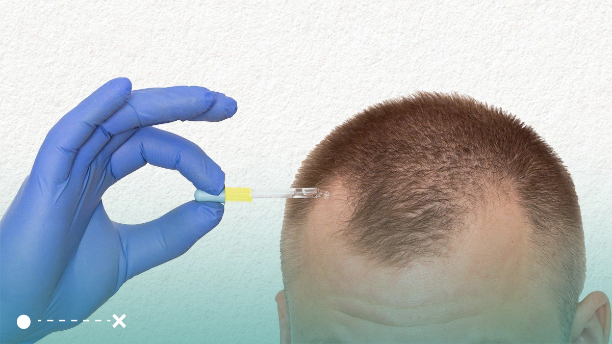 تشهد زراعة شعر مقدمة الرأس في تركيا تطوراً كبيراً وتعطي نتائج مبهرة.