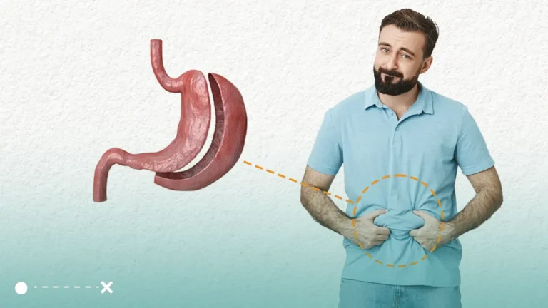 شكل المعدة بعد التكميم يختلف من حالة إلى أخرى ولكن بشكل عام تأخذ الشكل الأنبوبي.