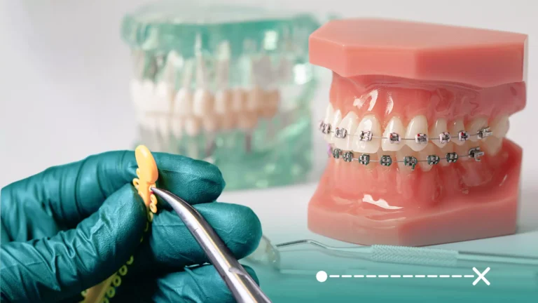 مطاطات تقويم الأسنان خطوة هامة في تقويم الأسنان وتستخدم للحفاظ على مواضع الأسنان.