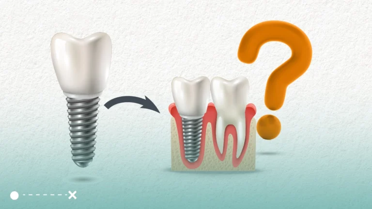 بعد زراعة الاسنان يحدث الكثير من التغيرات الايجابية حيث سيلاحظ المرضى نتائج ايجابية على صحة الفم والاسنان بشكل عام.