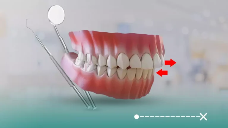 تقدم الفك العلوي من الحالات المرضية الشائعة، تختلف أسبابها وعلاجها من شخص لآخر.